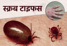 भारतको उडिसामा स्क्रब टाइफसको सङ्क्रमण बढ्यो